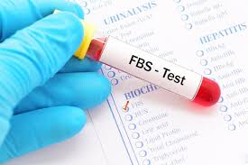 Blood sample being taken for FBS fasting blood sugar test