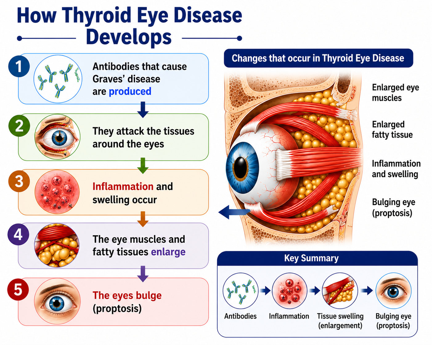 How Thyroid Eye Disease Develops — TRAb Antibodies Stimulate Orbital Fibroblasts Causing Proptosis